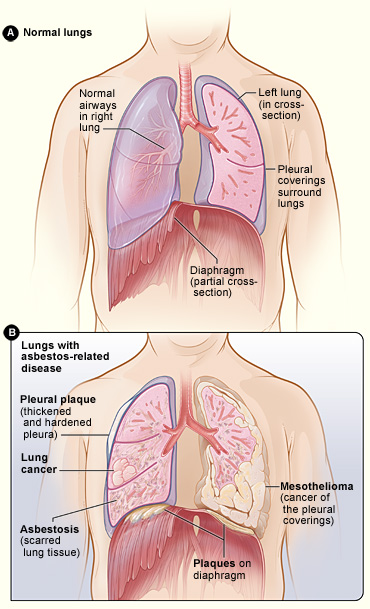asbestos lungs